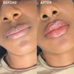 Aumento de labios (Lip Filler) - Vive Spa Med