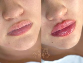 Aumento de labios antes y después - 873354