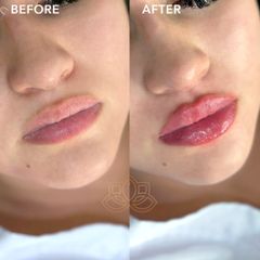 Aumento de labios (Lip Filler) - Vive Spa Med