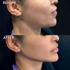 Acido hilauronico (Jaw Contour) - Vive Spa Med