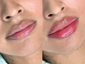 Aumento de labios antes y después - 873449