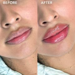 Aumento de labios (Lip Filler) - ViVe Spa Med