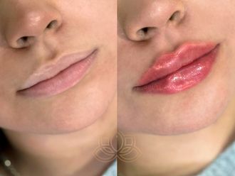 Aumento de labios antes y después - 873635