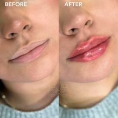 Aumento de labios (Lip Filler) - Vive Spa Med