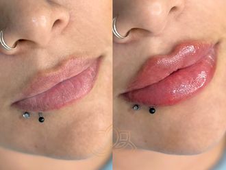 Aumento de labios antes y después - 873637