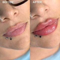 Aumento de labios (Lip Filler) - Vive Spa Med