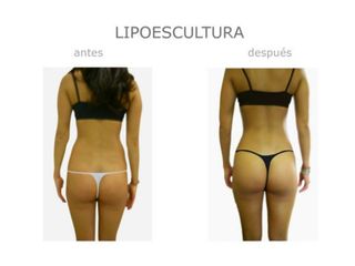 Antes y después de Lipoescultura