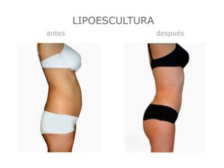 Antes y después de Lipoescultura