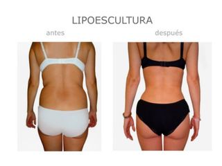 Antes y después de Lipoescultura