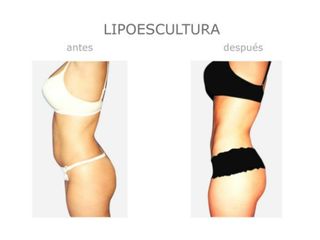 Antes y después de Lipoescultura