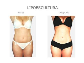 Antes y después de Lipoescultura