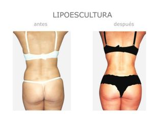 Antes y después de Lipoescultura
