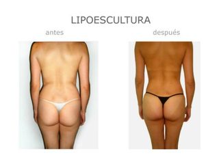 Antes y después de Lipoescultura