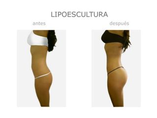 Antes y después de Lipoescultura