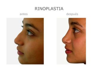 Antes y después deRinoplastia