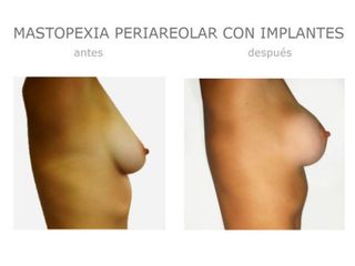 Antes y después de Mastopexia periareolar