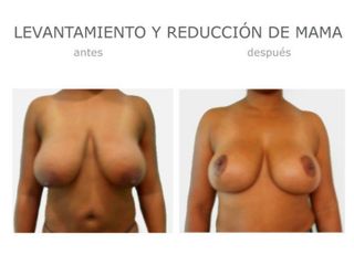 Antes y después de Levantamiento y reducción mama