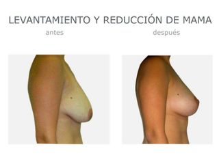 Antes y después de Levantamiento y reducción mama