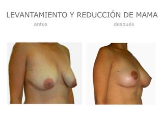 Antes y después de Levantamiento y reducción mama