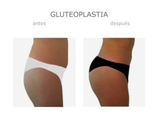 Antes y después de Gluteoplastia