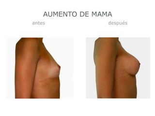 Antes y después de Aumento mama