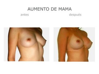 Antes y después de Aumento mama