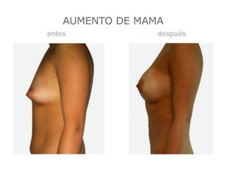 Antes y después de Aumento mama