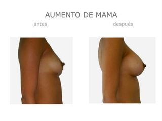 Antes y después de Aumento mama