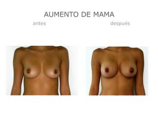Antes y después de Aumento mama