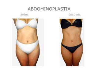 Antes y después de Abdominoplastia