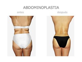 Antes y después de Abdominoplastia