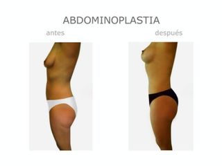 Antes y después de Abdominoplastia
