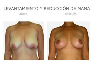 Antes y después de Levantamiento y reducción mama