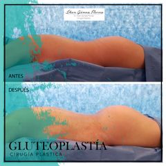Antes y después de gluteoplastía. Dr. Jhon Gómez Cirujano Plástico