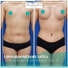Antes y después de Lipoabdominoplastia + Implantes 300 CC