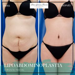 Antes y después de Lipoabdomindoplastia