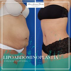 Antes y después de Lipoabdomindoplastia
