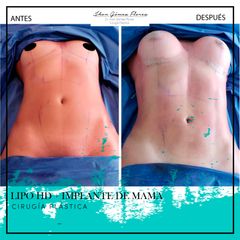 Antes y después de Lipo + Implante de busto