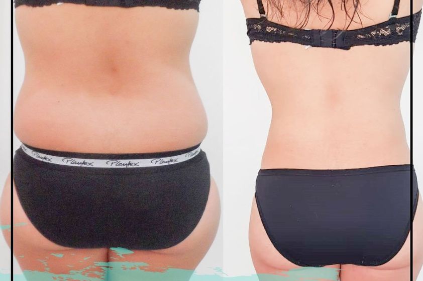 Liposucción antes y después - 660702