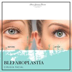 Antes y después de Blefaroplastia -Dr-Jhon