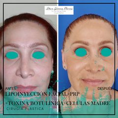 Antes y después de Lipoinyección facial- Dr. Jhon
