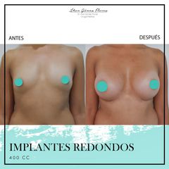 Antes y después de Implanets redondos 400-CC Dr. Jhon