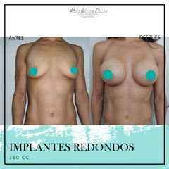 Antes y después de  Implantes redondos 350 CC Dr Jhon