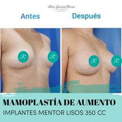 Antes y después de  Implantes lisos 350 CC