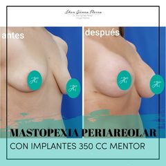 Antes y después de  Implantes 350 CC Dr. Jhon
