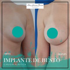 Implante bustot 300cc Dr. Jhon Gómez 