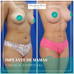 Antes y después de implantet de mamas