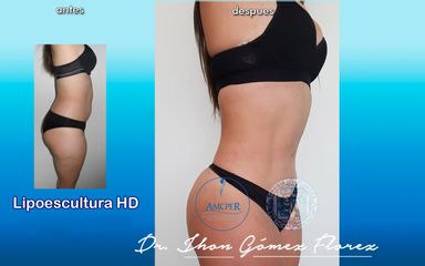 Antes y después de lipoescultura
