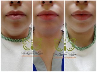 Aumento de labios - Dra. Alejandra Rodríguez