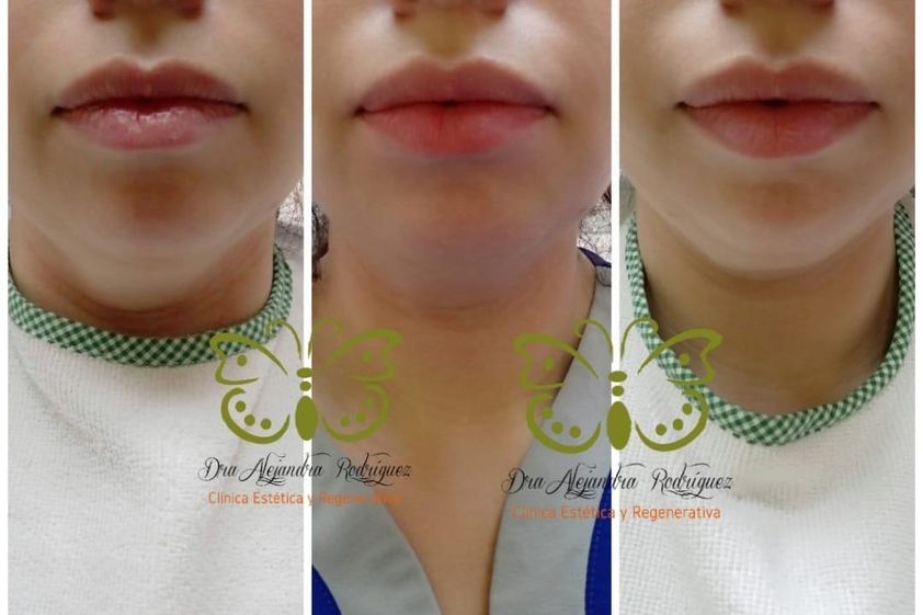 Mesoterapia antes y después - 868152